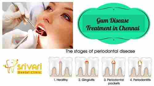 Periodontics Gum Treatment Services
