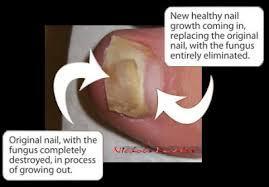 Undecanoic Acid - Nail Care Product