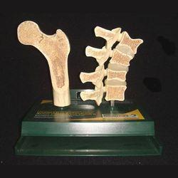 Safe To Use Femur & Vertebrae Osteoporosis Model