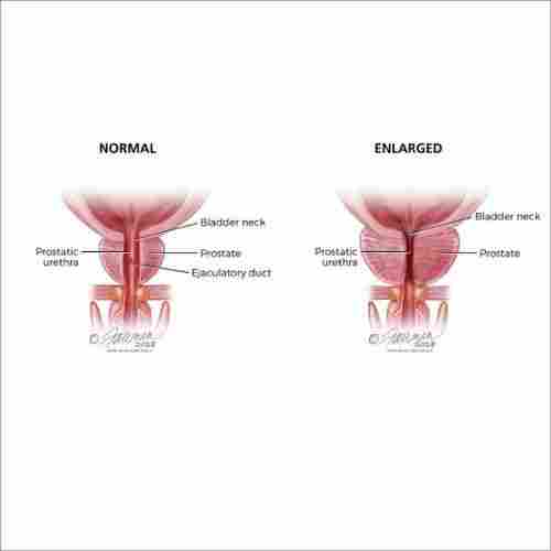 Prostate Cancer Natural Herbal Treatment Services Without Side Effects