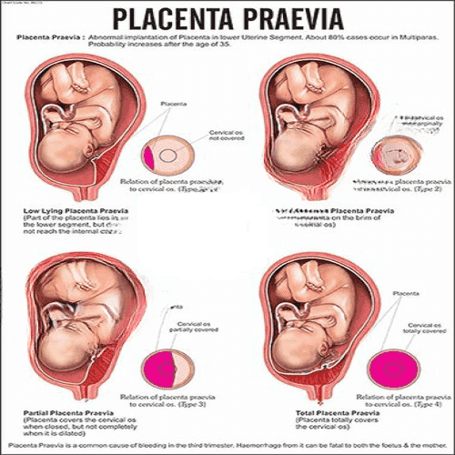 INC13 Placenta Praevia