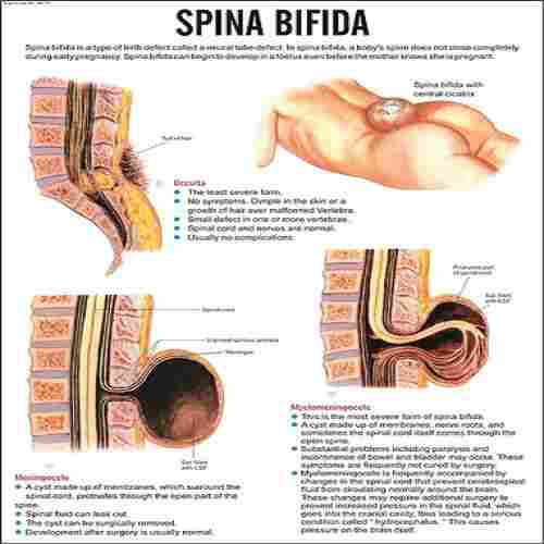 INC17 Spina Bifida