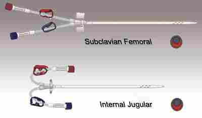 Hemodialysis Catheter