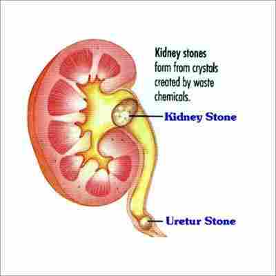 Kidney Disease Homeopathy Treatment