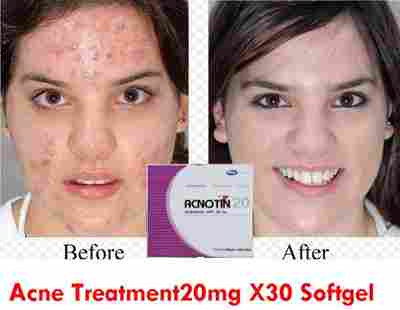 Acnotin 20Mg Acne Treatment 30 Capsule, Remove Cystic Acne