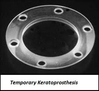 Marble Temporary Keratoprosthesis