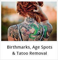 Birthmarks Age Spot And Tattoo Removal Service
