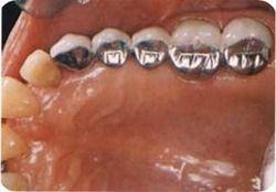 Metal Teeth