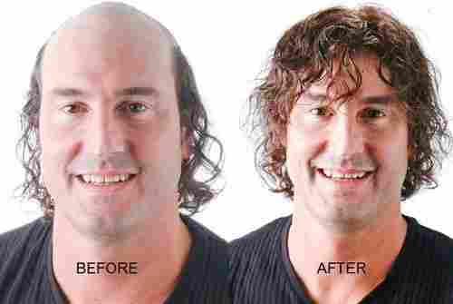 Non-Surgical Hair Replacement Solution
