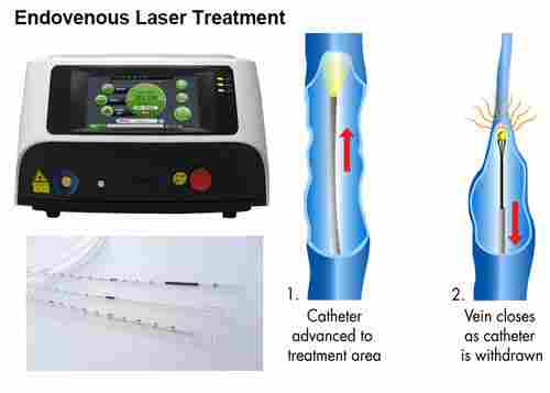 Varicose Veins Laser Treatment Laser Ablation Varicose Veins