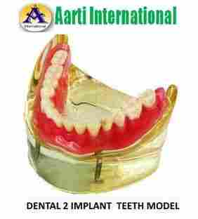 Dental 2 Implant Teeth Model