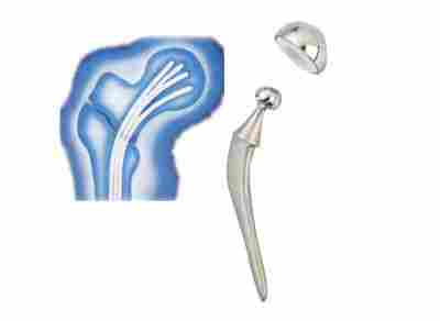 Knee Replacement Implants