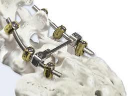 Poly Axial Pedicle Screw Spinal Implants