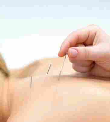 Modern Safe Acupuncture Needles