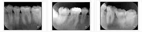 Dental X Ray Films