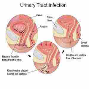 Urinary Tract Infection Treatment Service