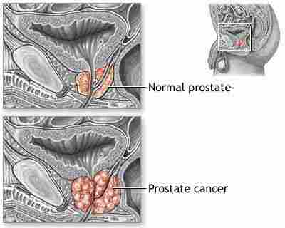 Prostate Cancer Treatments Services