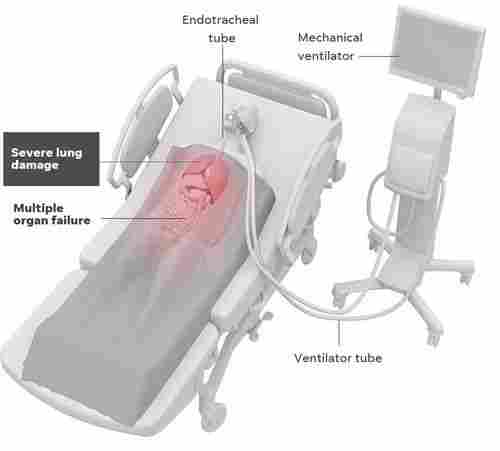 Lung Ventilator