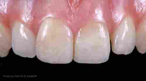Dental Teeth Ceramic Or Ceramic Crown