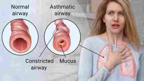 Aasthma Treatment Package Service